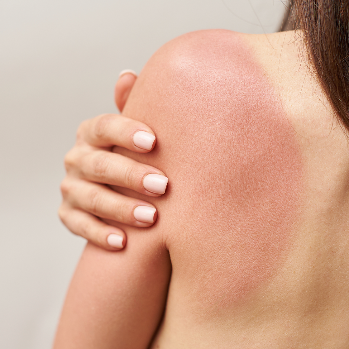 LES COUPS DE SOLEIL : CAUSES, EFFETS SECONDAIRES ET OPTIONS DE TRAITEMENT