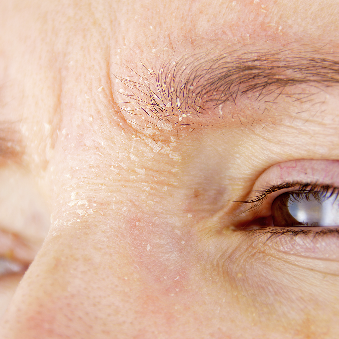 COMMENT REM&Eacute;DIER &Agrave; LA PEAU S&Egrave;CHE, SQUAMEUSE ET QUI P&Egrave;LE SUR LE VISAGE, EN PARTICULIER AUTOUR DU NEZ, DE LA BOUCHE ET DES YEUX?