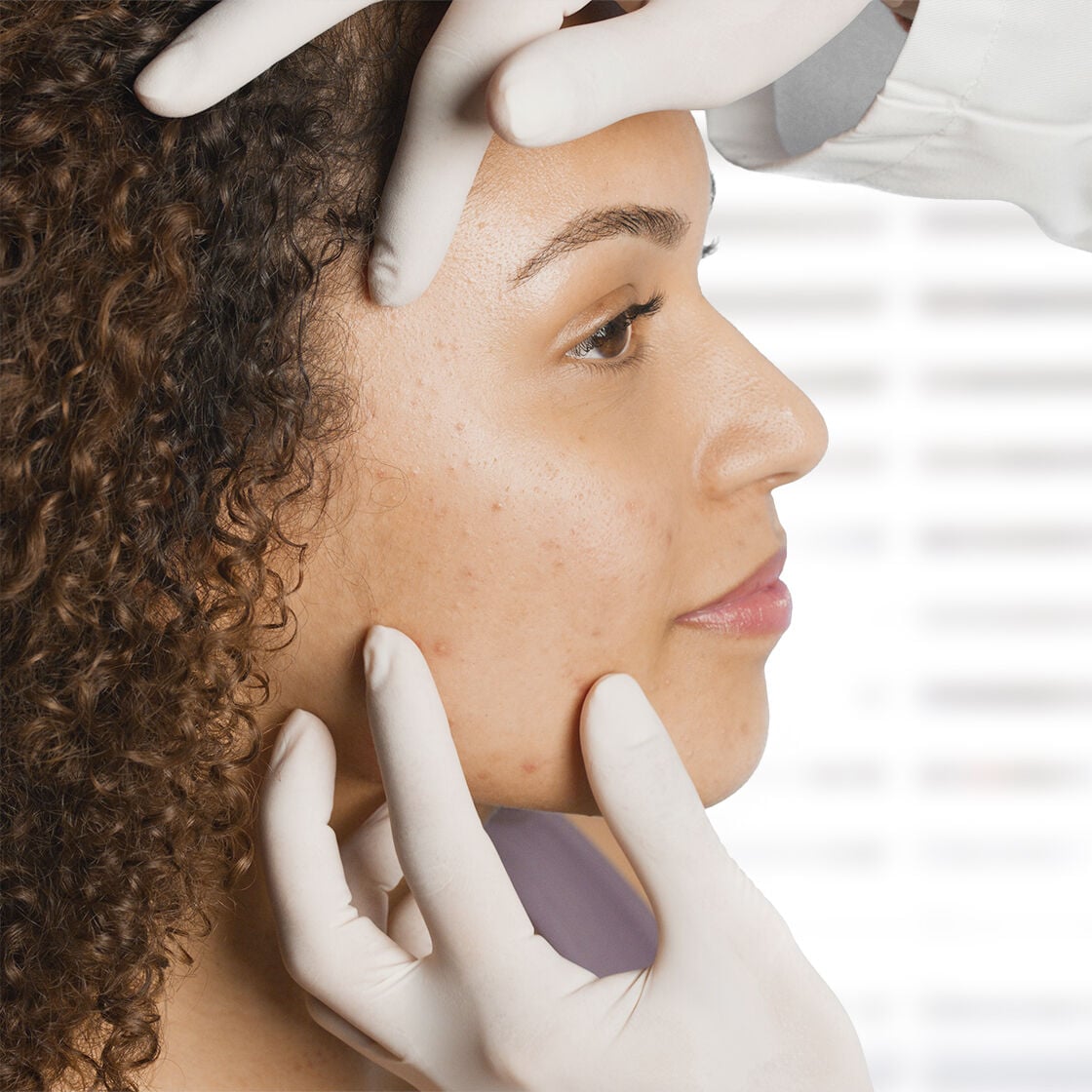 COMMENT AVOIR UNE PEAU NETTE : TRUCS POUR TRAITER LA PEAU SUJETTE &Agrave; L'ACN&Eacute;